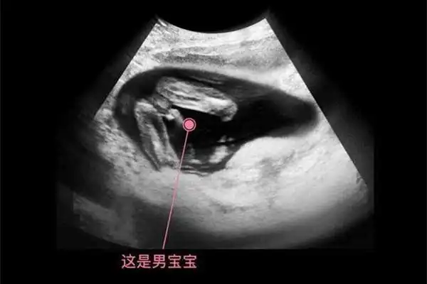 脊柱呈串珠样排列是男孩女孩 脊柱看男女的技巧