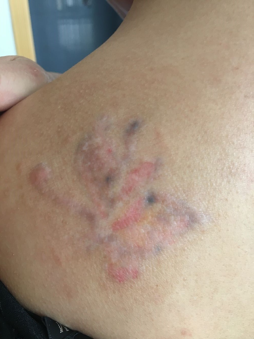 洗彩色纹身:洗纹身论坛重庆辣妈洗后背蝴蝶文身,第一次治疗恢复中图片