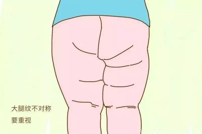 几个小细节教你查看宝宝发育状况,腿纹对称就是其中一个,快学