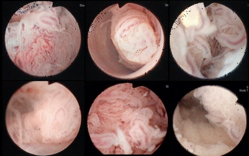 再者,很多子宫异常出血,超音波下见子宫内膜很厚的情况下,在经过子宫