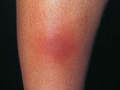 人工性脂膜炎的症状和图片 - 有来医生