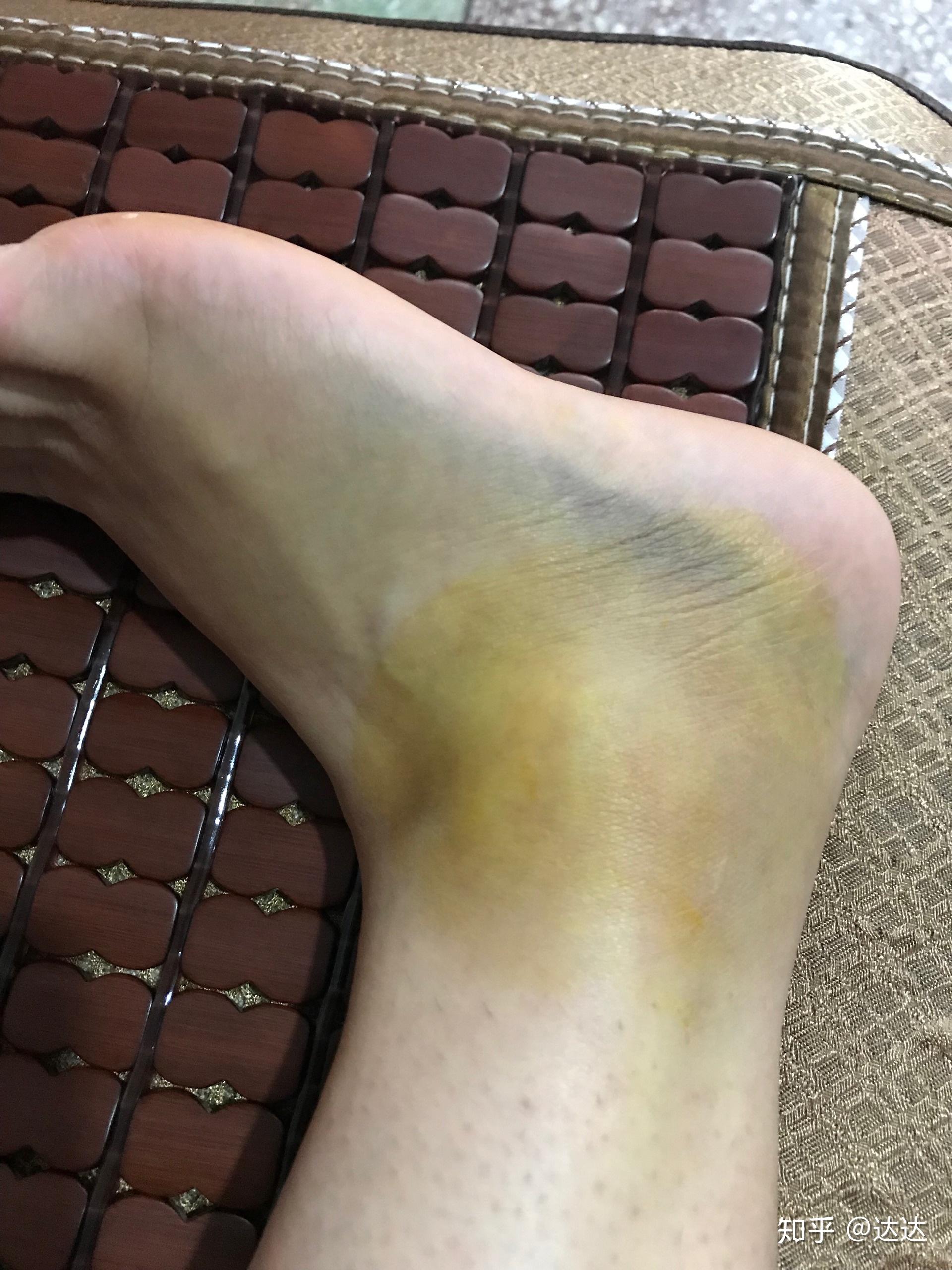 脚踝扭伤全记录