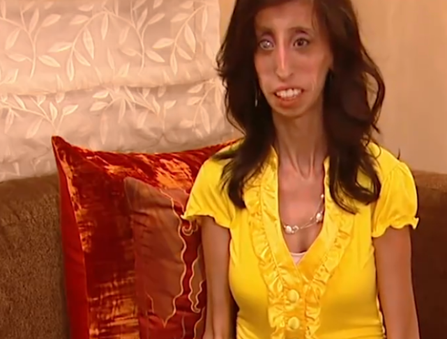 世界上"最瘦"的女人,身高1米58仅有20千克,若不拍下谁相信