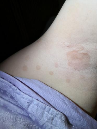 我老婆腋下有很多圆圆的黑斑,这是怎么回事呀?