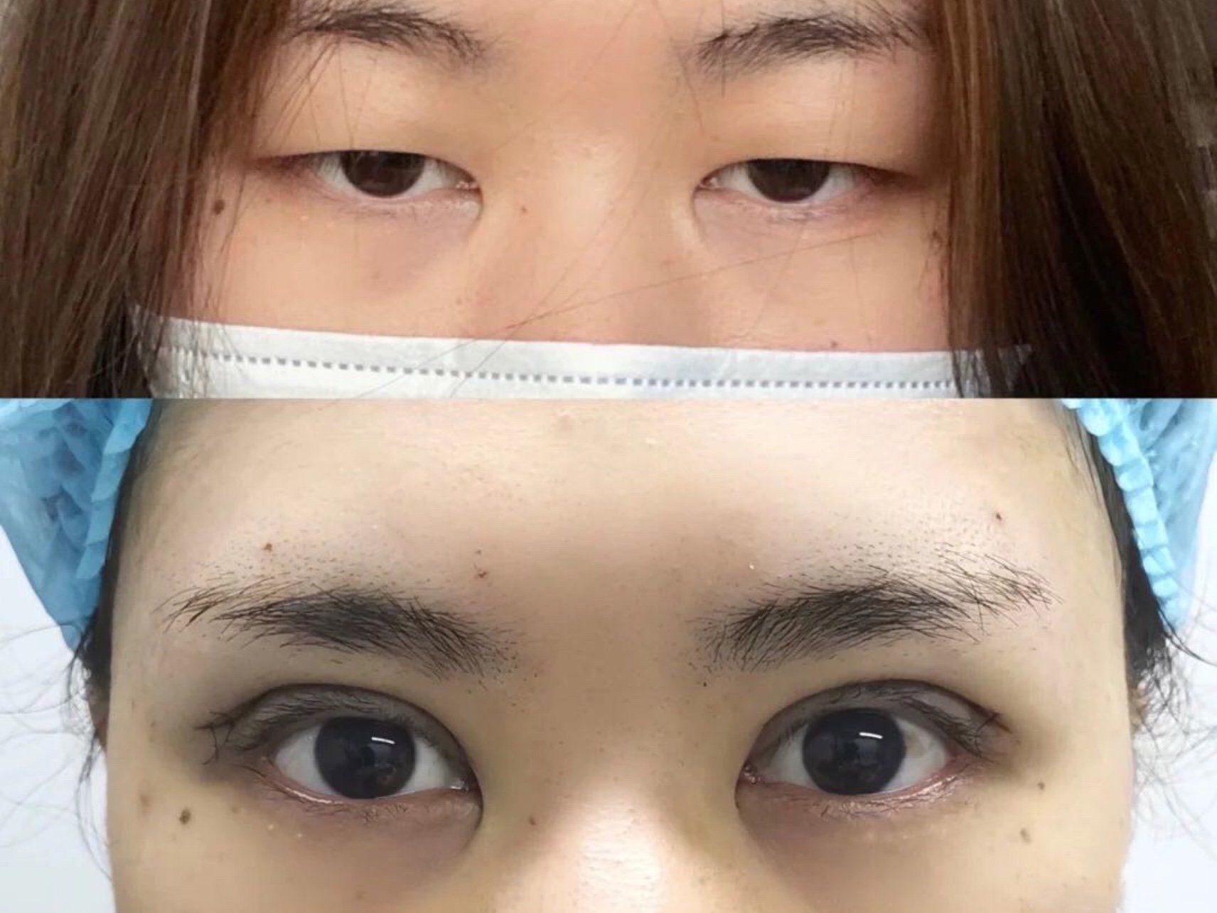 切割双眼皮术后恢复!#全切双眼皮