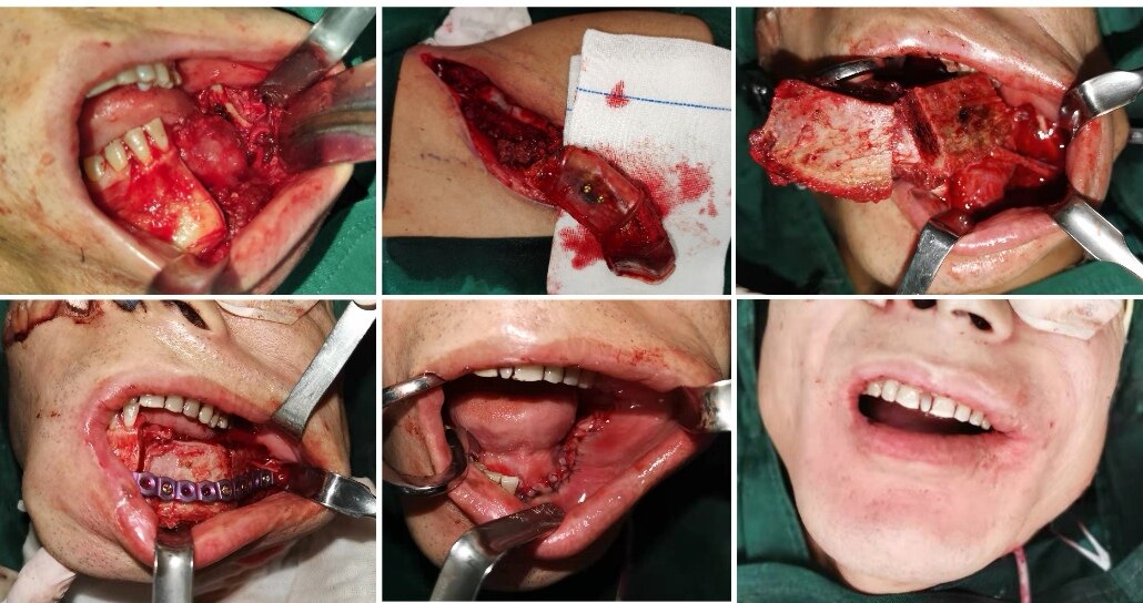 没有面部切口的颌骨肿瘤切除及修复重建微创技术 - 好大夫在线