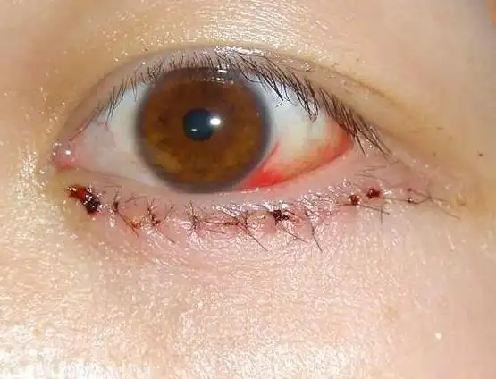 切眼袋的后遗症图片千万别看,手术去眼袋后遗症不容忽视?