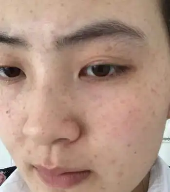 脸上长斑的原因是什么