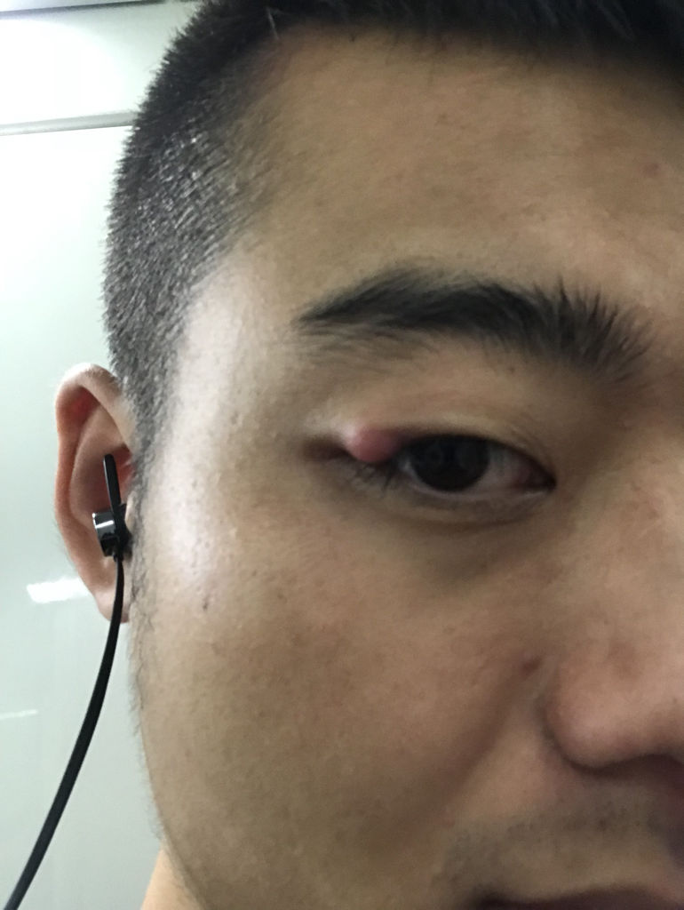 眼皮上长了个东西