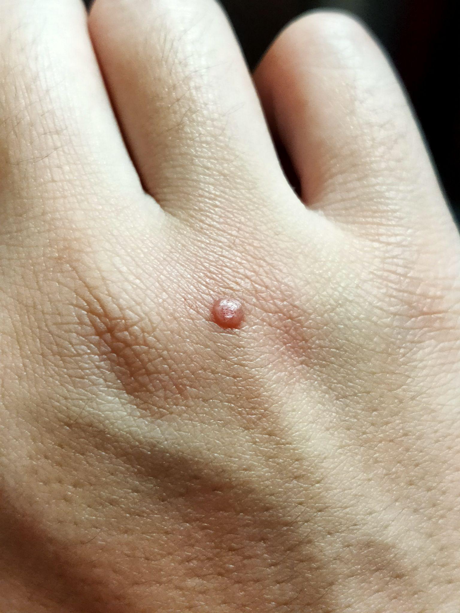 一开始是红色,过几天出现了角质化——"恭喜"我,获得了又一个寻常疣