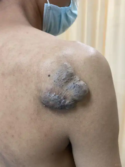 【义诊患友治疗追踪】甘肃青年肩部静脉畸形(更新至11月)_血管瘤论坛