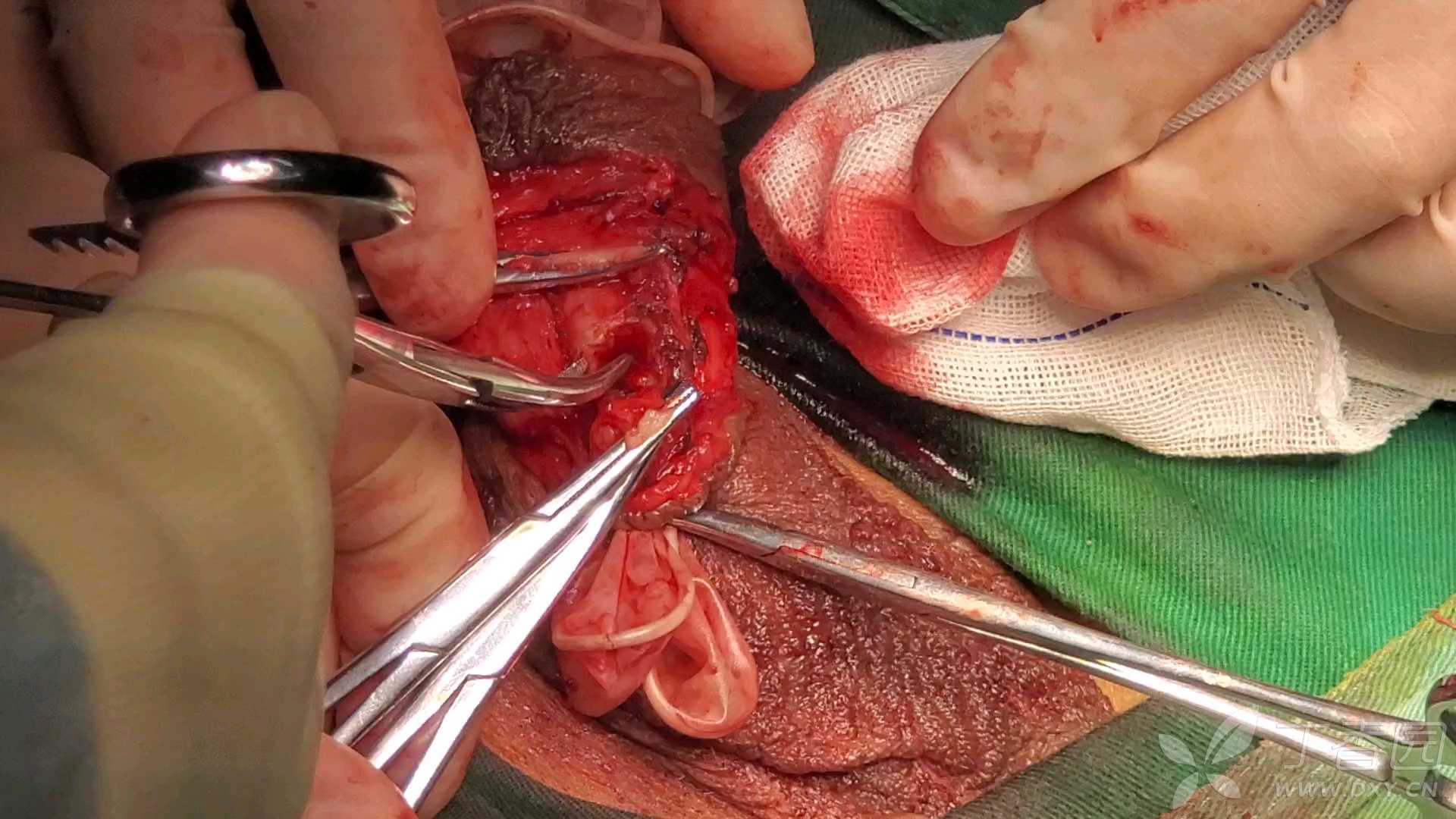 【阴茎ca】 阴茎次全切,尿道造口 手术视频04