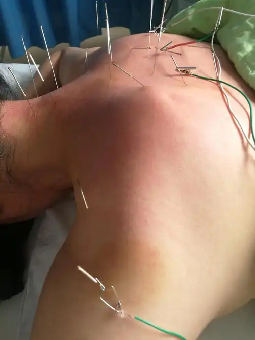 后背酸沉痛针刺 针灸推拿讨论版 基层医生论坛