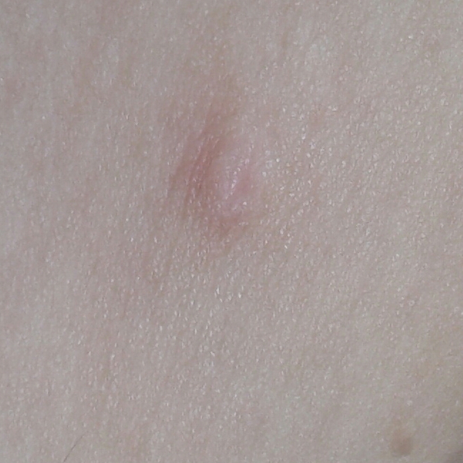 我两边腋下都长了这个像乳头的东西,这个到底是什么啊,有点担心.