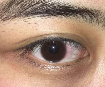 眼角膜发炎图片 (36)