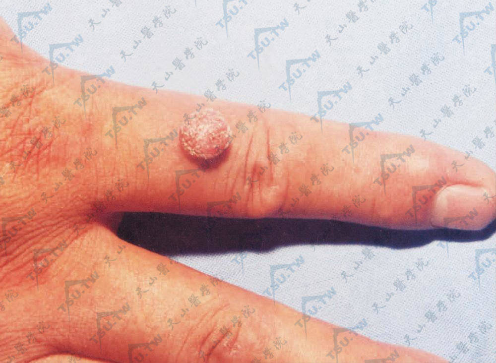 疣:乳头瘤病毒感染皮肤病(病因,症状,诊疗)