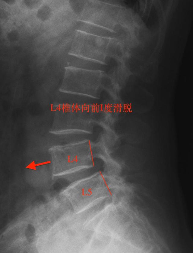 脊椎滑脱的手术治疗