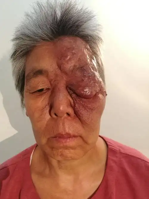 面部血管瘤一例