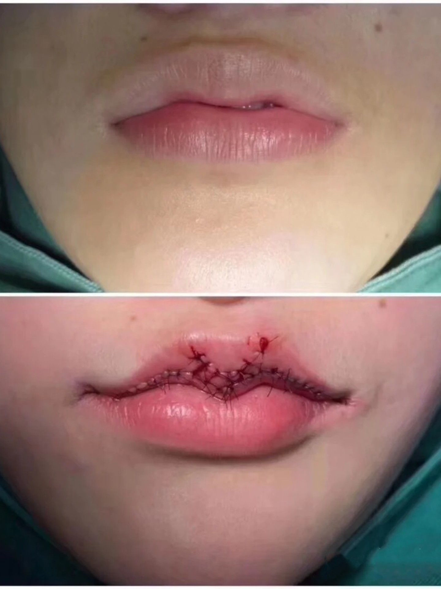 做了媚唇手术,之前一直对自己嘴长的很不满意,终于下定决心做了它了.