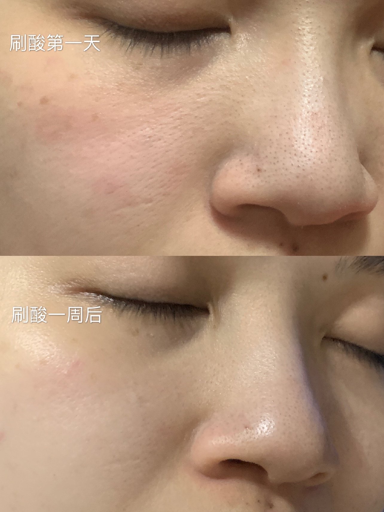 果酸焕肤一周后