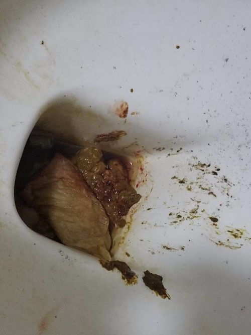 男生拉屎拉出血了是怎么回事,大便突然拉了一滩血怎么回事_竞价网