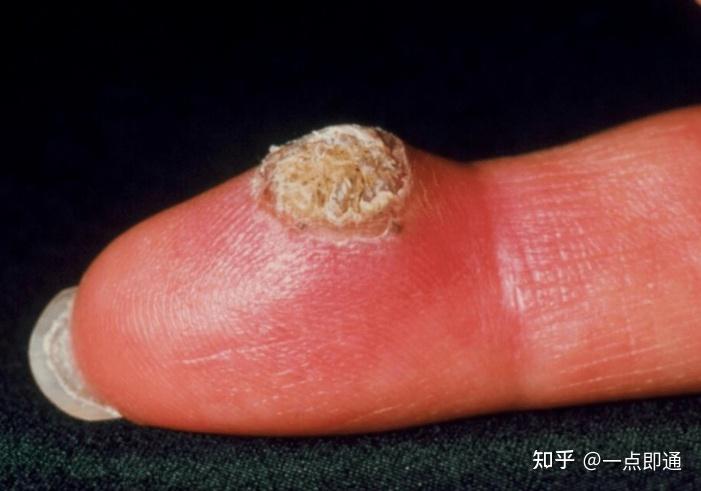 但是实际上,hpv病毒的感染并不分男女,只不过男性的免疫力相对好一些