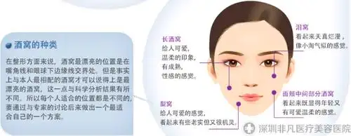 酒窝成形术_酒窝再造前后对比照片