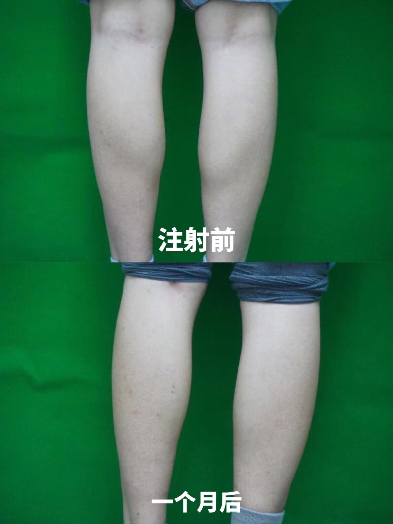 98瘦腿针已经打了一个月了,之前腿围一只腿33,一