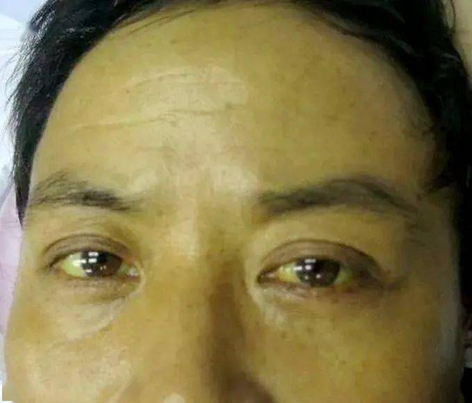 健康知识肝病早期有7个症状4个地方会变红3个部位会变黄