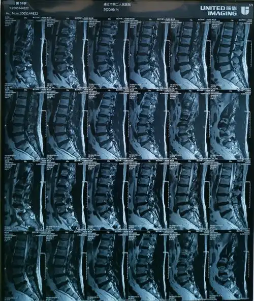 腰间盘突出椎间孔镜手术四例