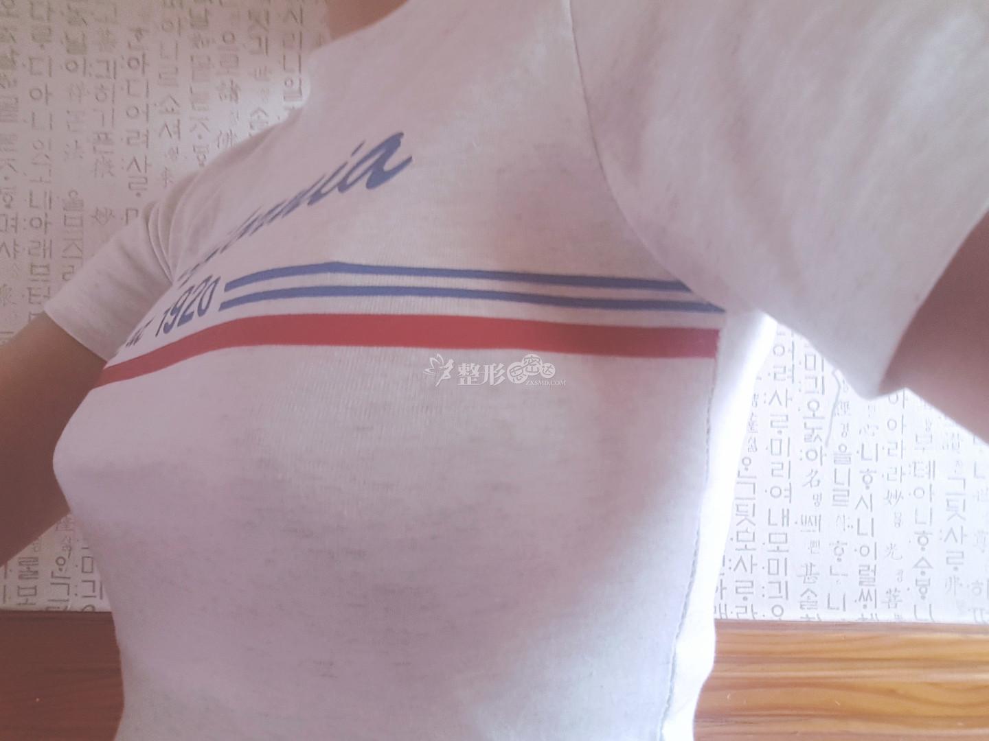 赛彬胸12天,"胸"感强烈_韩国整形社区_韩国整容问答_韩国整形经验交流