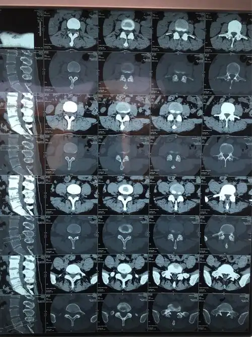 旁中央型腰间盘突出症病人.39岁女性病人