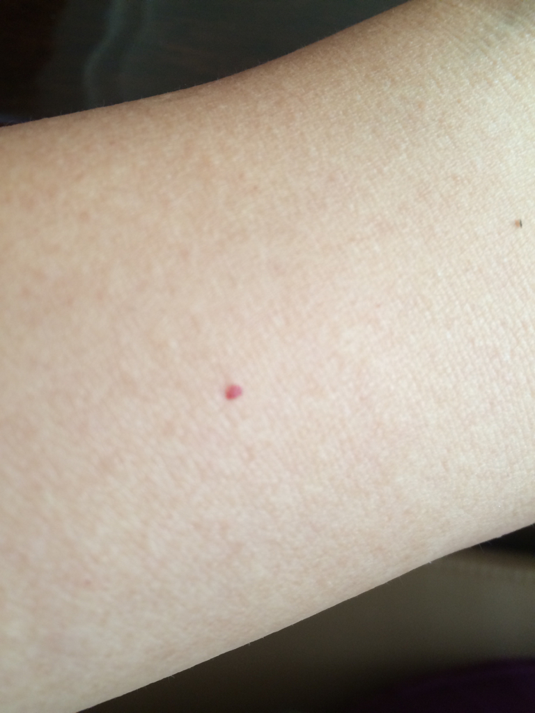 40多岁皮肤出现红血点怎么办?