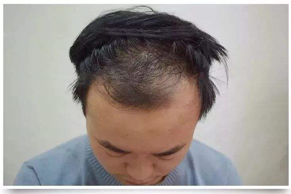 发际线后移擦生姜行吗