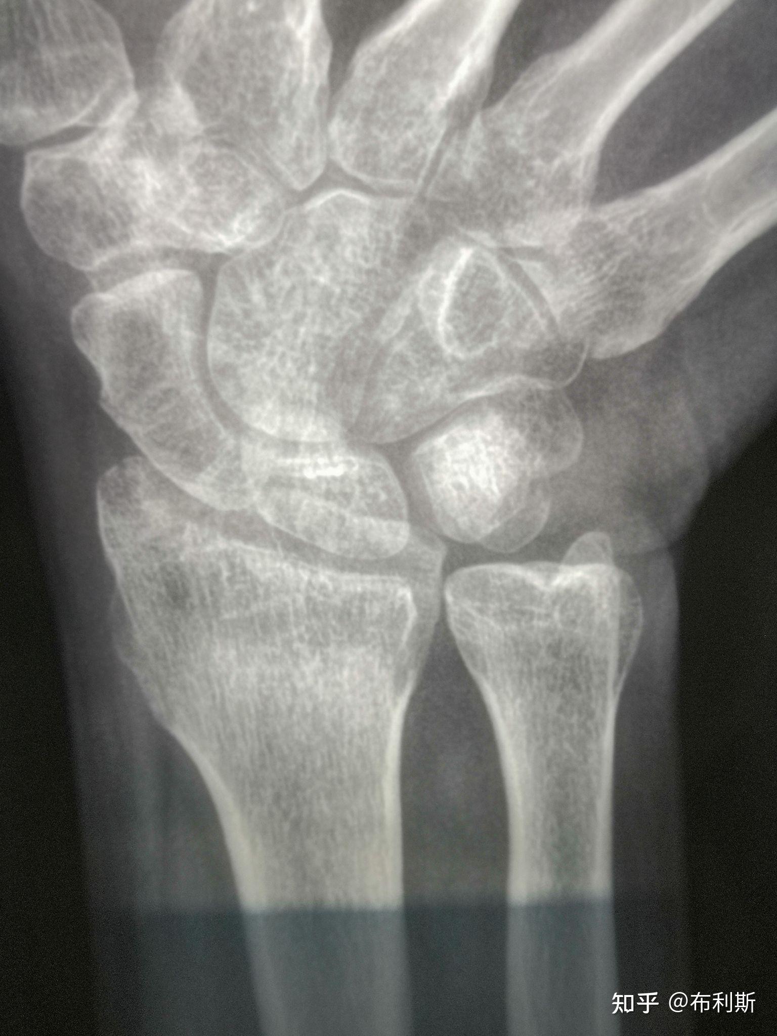 右手腕舟状骨骨折