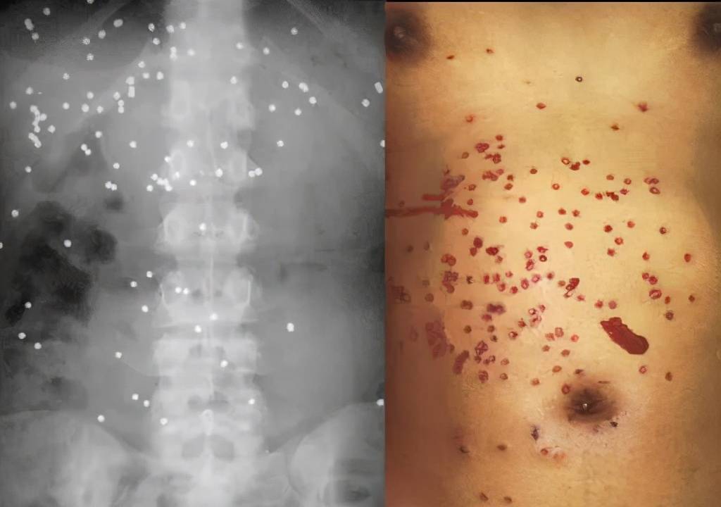 出高能量创伤的特点——大面积的伤口会深入到肌肉组织并破坏血循环