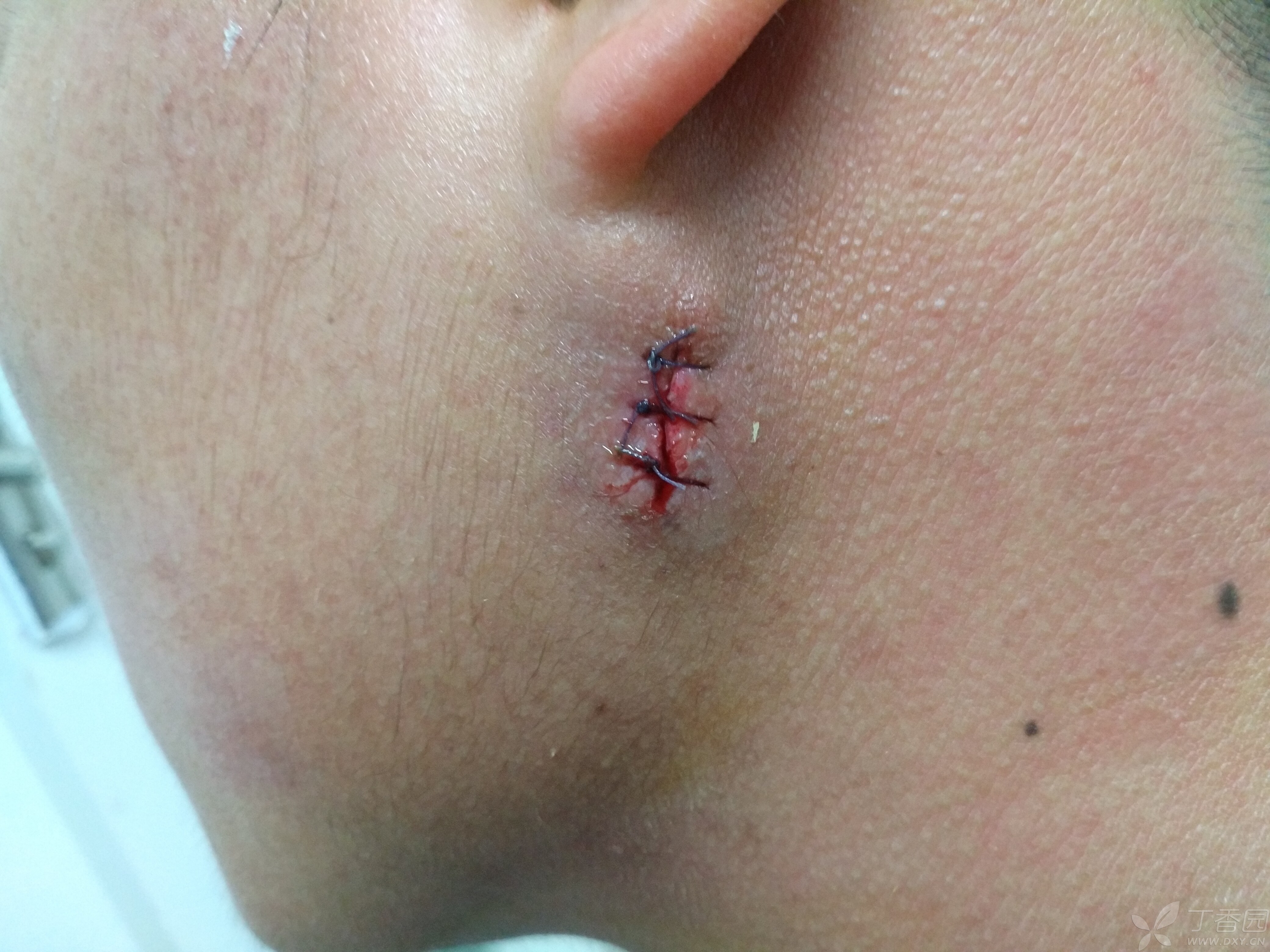 感染的治疗,一直不是很明确应该是口服药物抗感染,等炎症消除后在手术