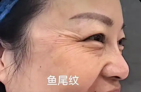 眼部下面的纹叫啥纹,鱼尾纹,鸡爪纹不知道该怎么处理 - 玉三网