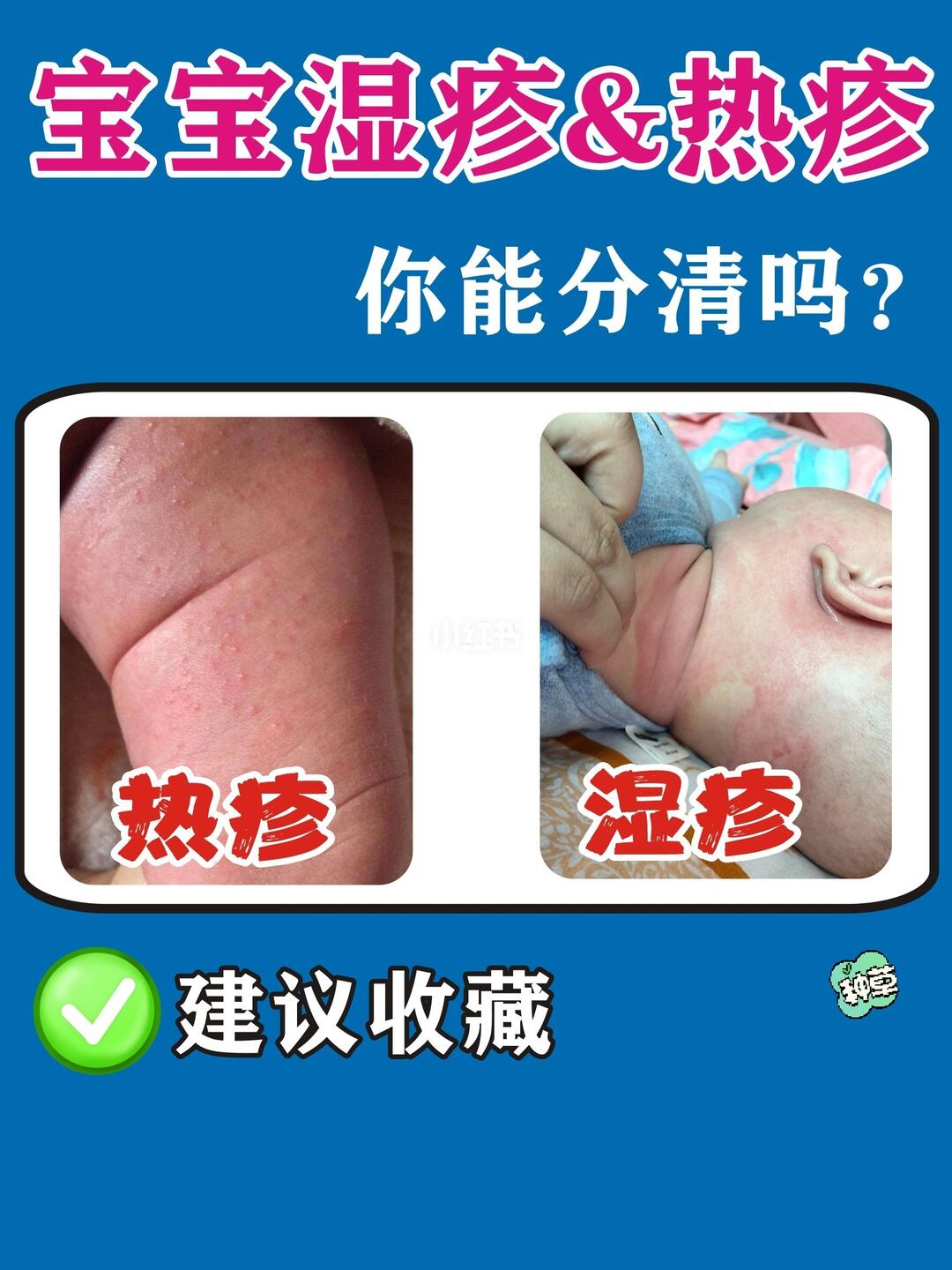 宝宝湿疹热疹一分钟认清,乱护理可不行