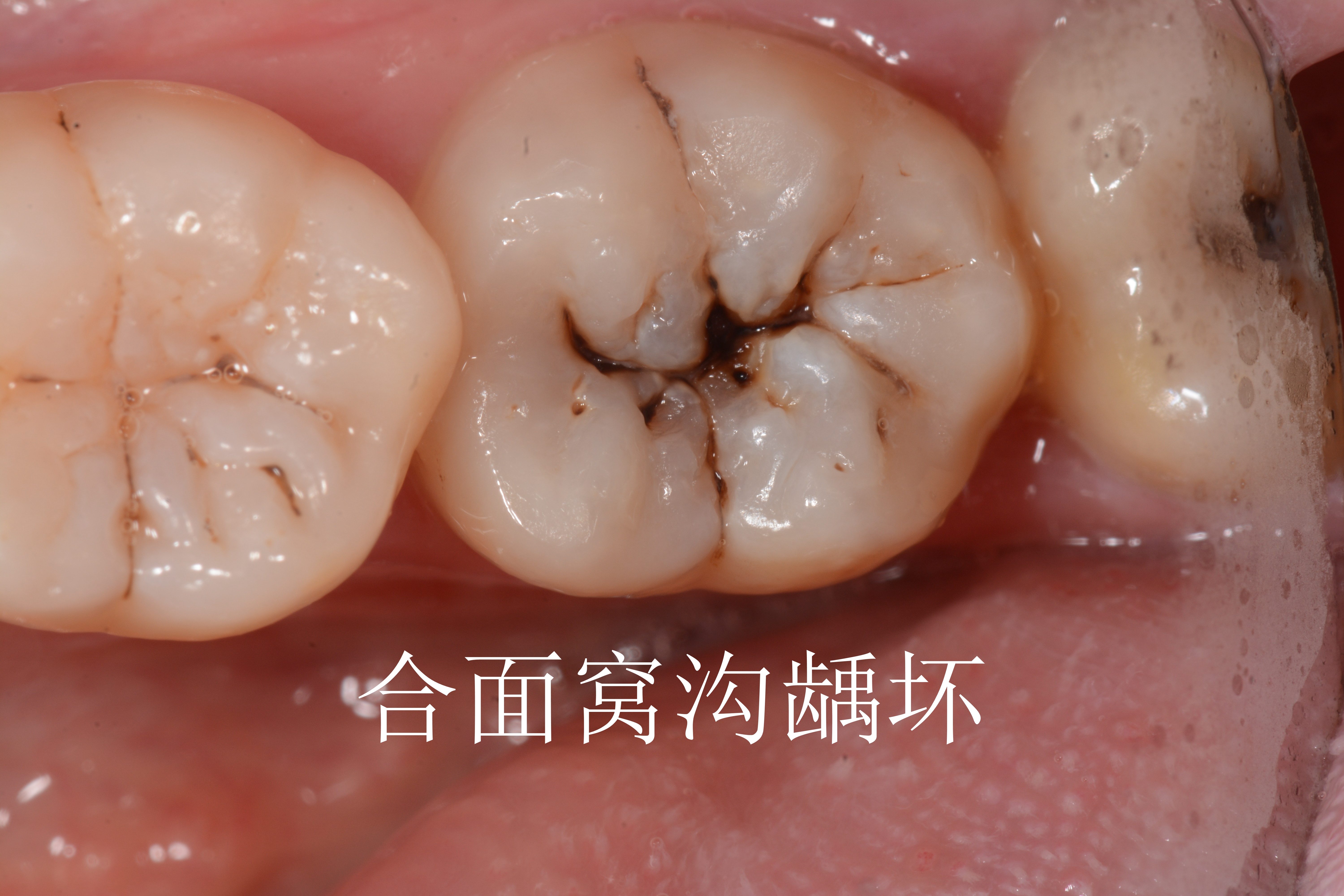 牙齿的好发龋损位置:一般合面(咬东西的面)>邻面(牙间牙面)>唇颊侧的