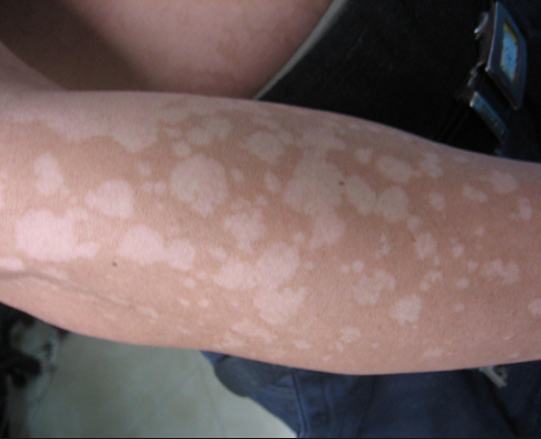 花斑癣是怎么引起的