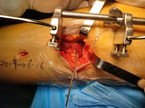 直视下见关节面平整,高度恢复,关节面下直径1.5mm 克氏针固定.