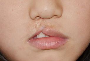 痛在娘心的唇腭裂如何预防比较好