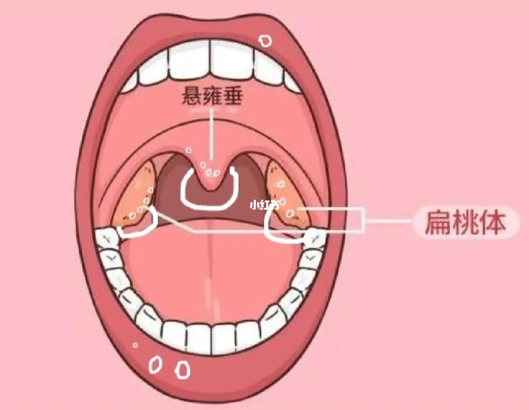 挪开悬雍垂看到的)喷药还喷不到好疼啊还伴随着咳嗽#口腔溃疡怎么办