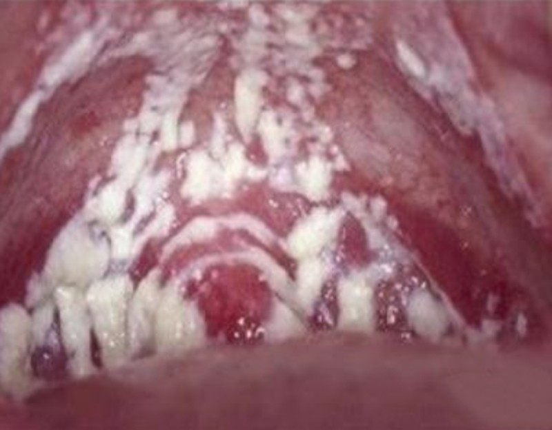 妇科疾病霉菌阴道炎图片_有来医生