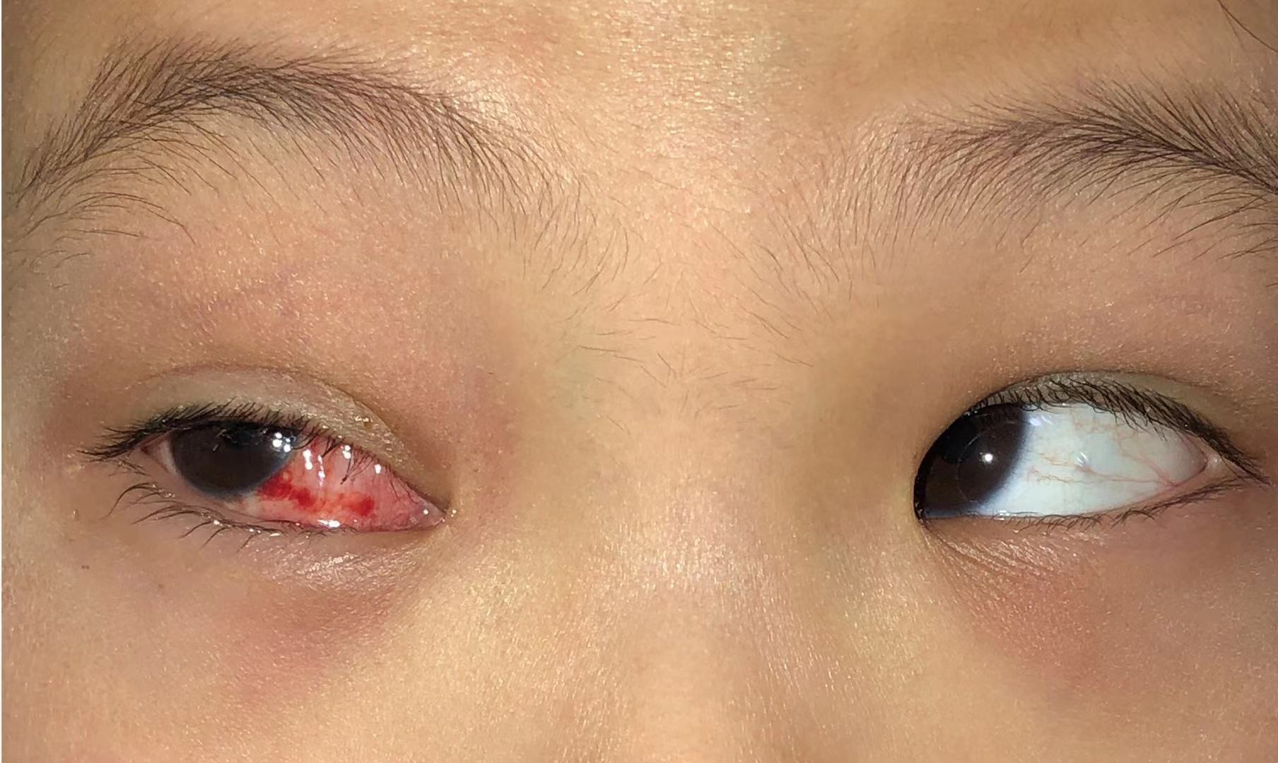 小儿斜视_小儿斜视治疗方式 - 好大夫在线