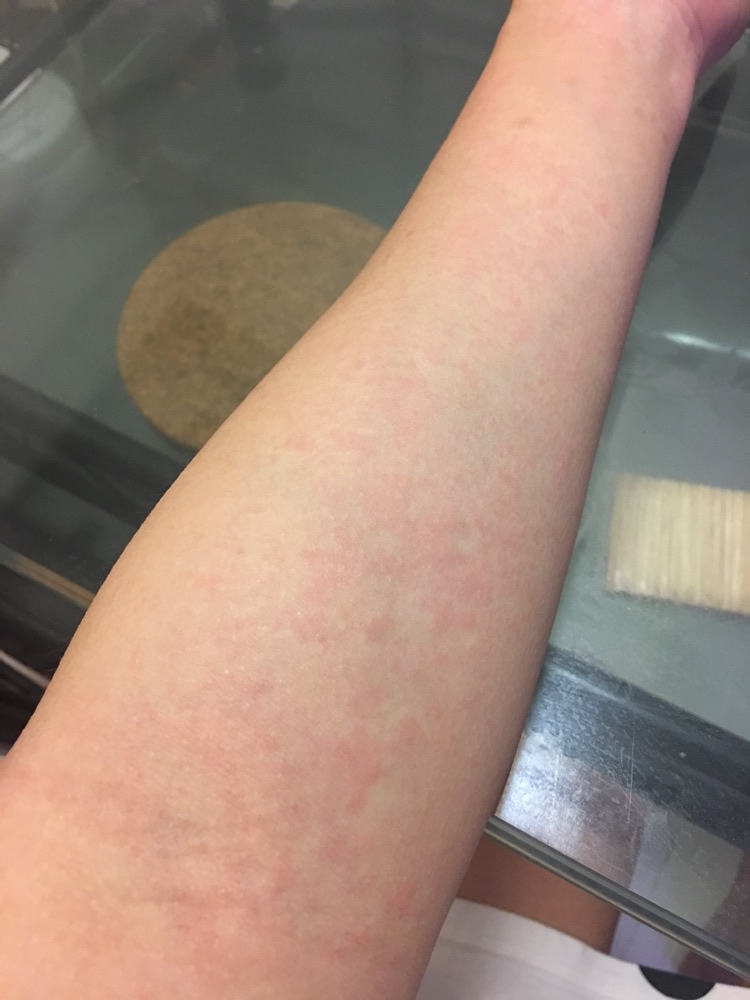 今天突然全身起红疹特别痒