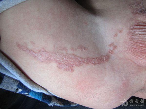 病历讨论线状表皮痣