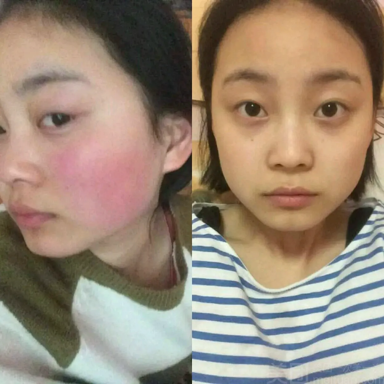 红血丝敏感肌激素脸修护