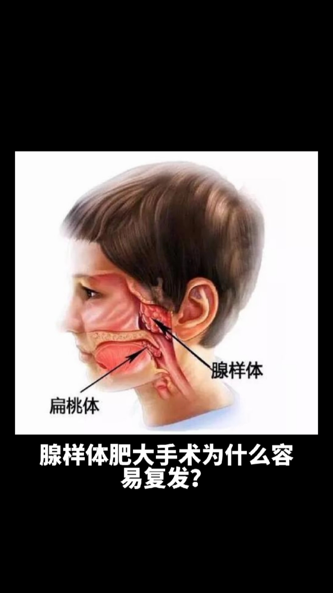 育儿#腺样体肥大手术后复发几率还是很大的,所以即使切了,也要注意
